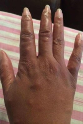 Bedbug bites on black hand