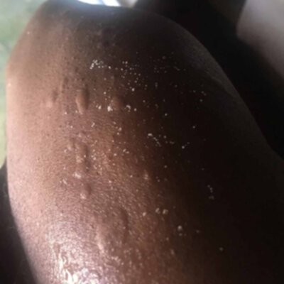 Swollen Bed bug bites on black skin