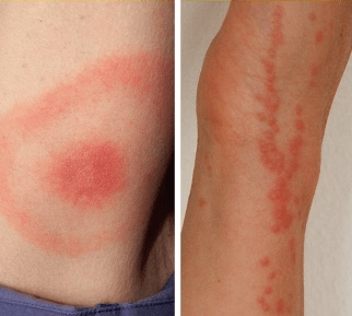 tick bites left and bed bugs bites right