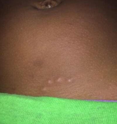 Bed bug bites in a line and on black skin (stomach)
