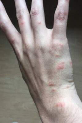 Bedbug bites on white hand