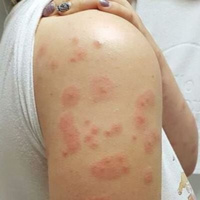 Swollen Bed bug bites on white skin